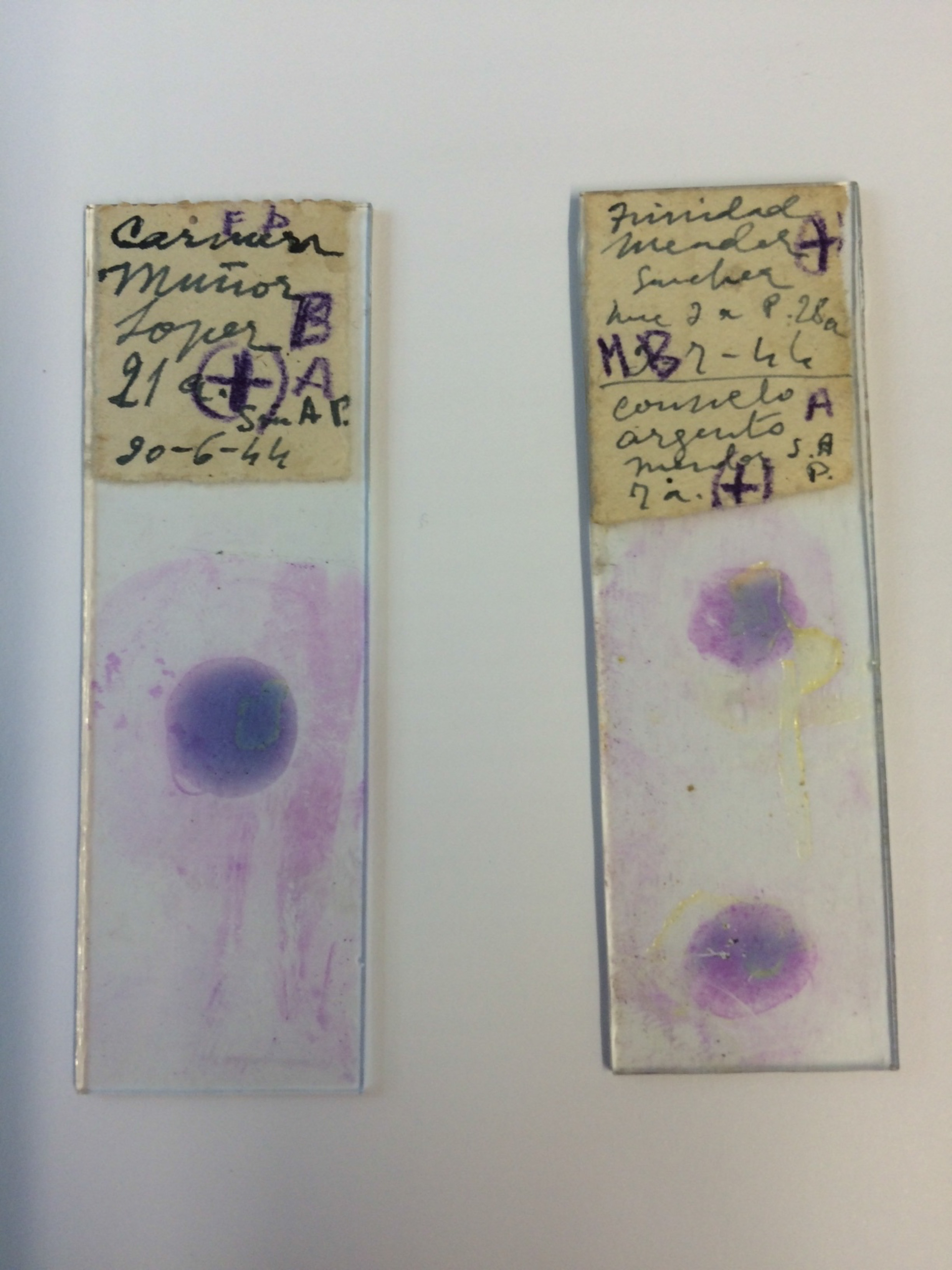 70 year old malaria patients slides.