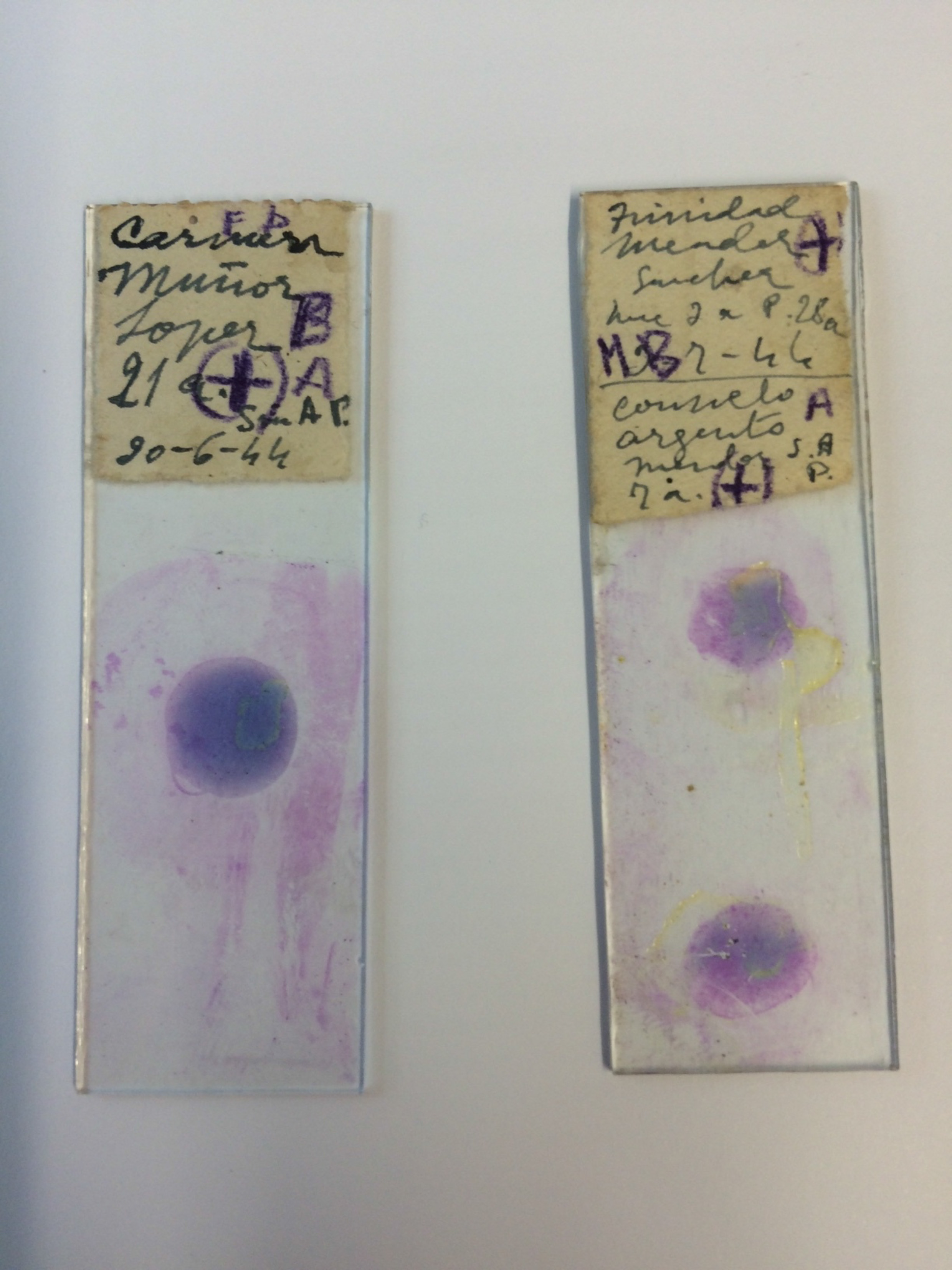 70 year old malaria patients slides.